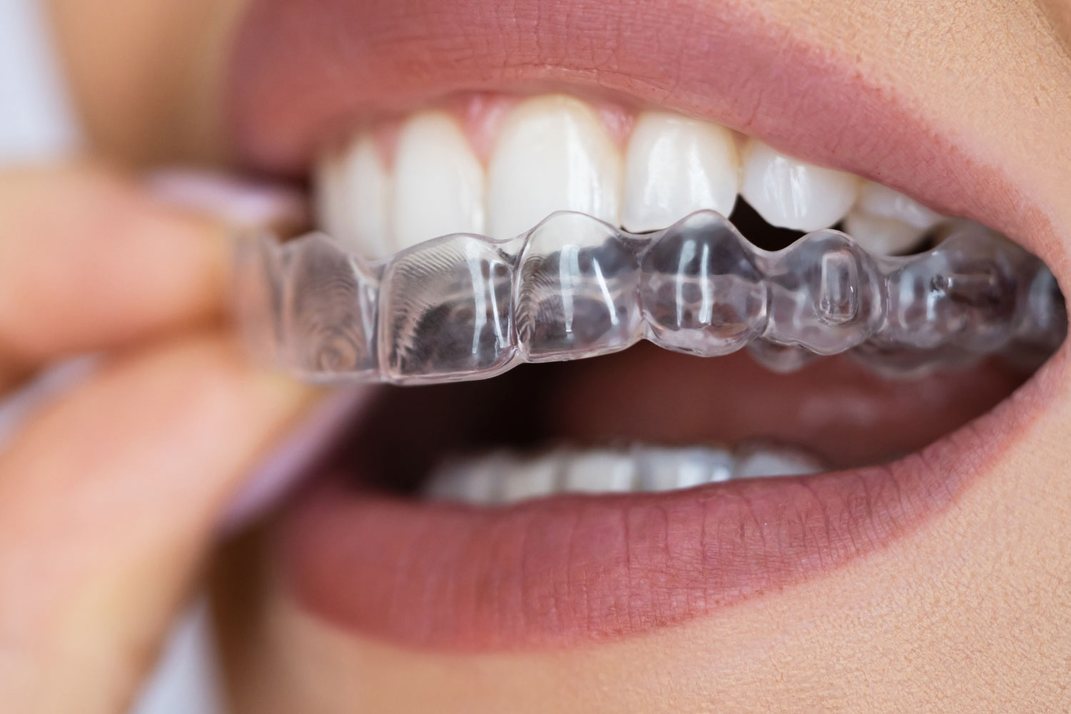 Clear aligner therapy