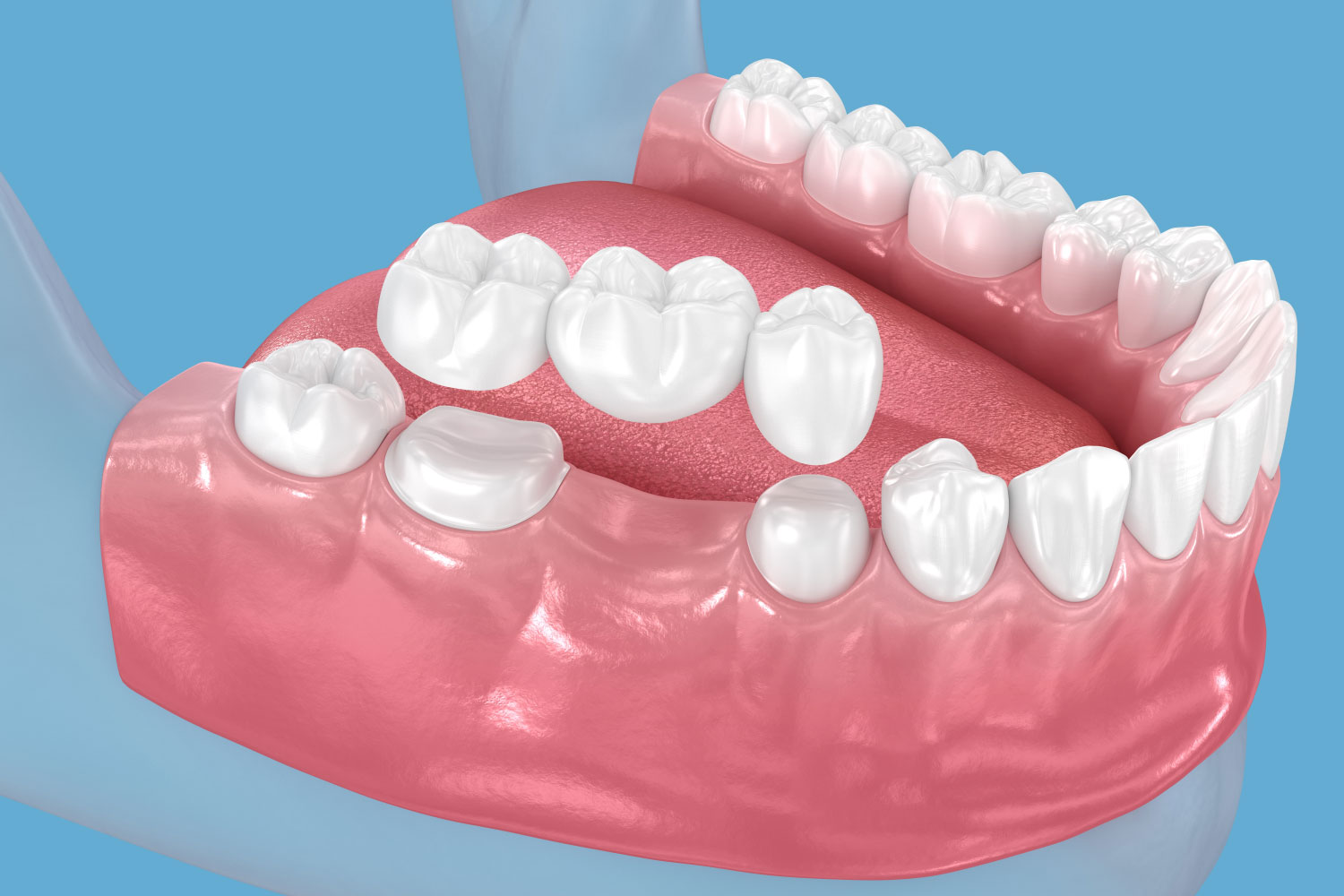 Dental bridge