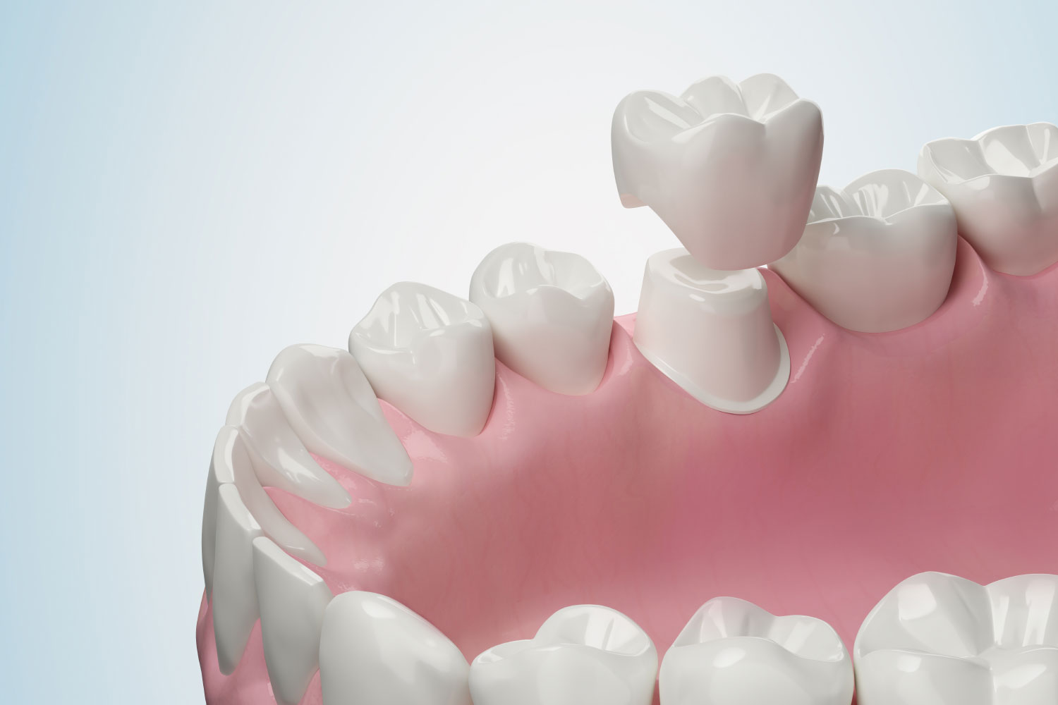 Dental crowns