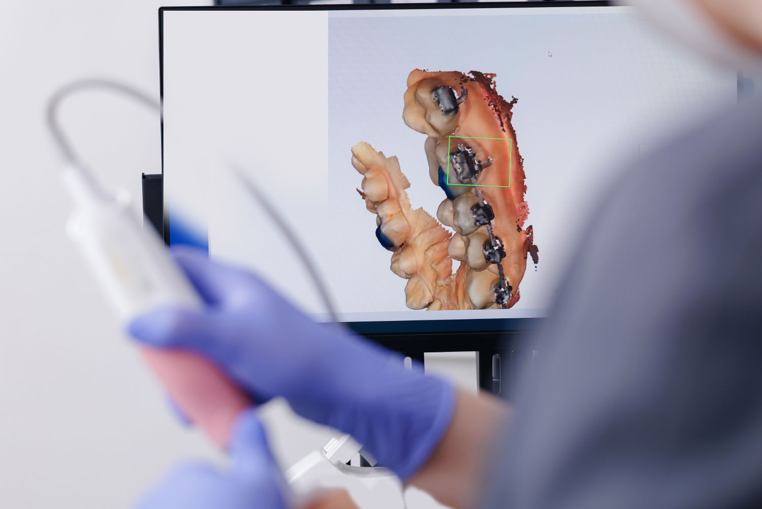 Dental digital impressions