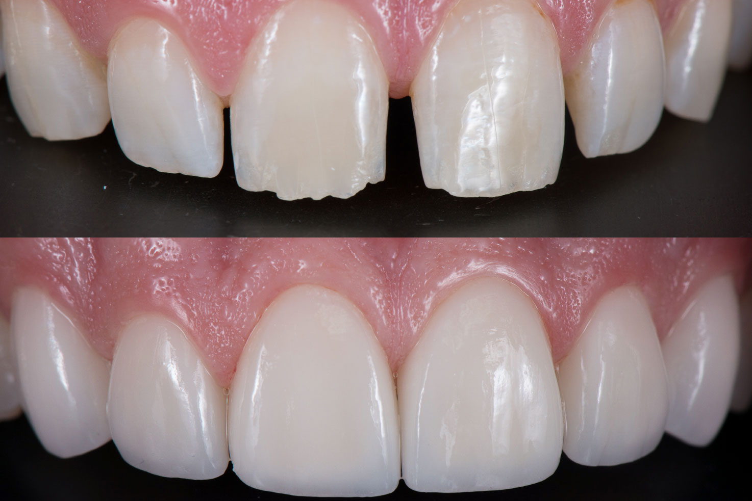 Dental esthetic bonding