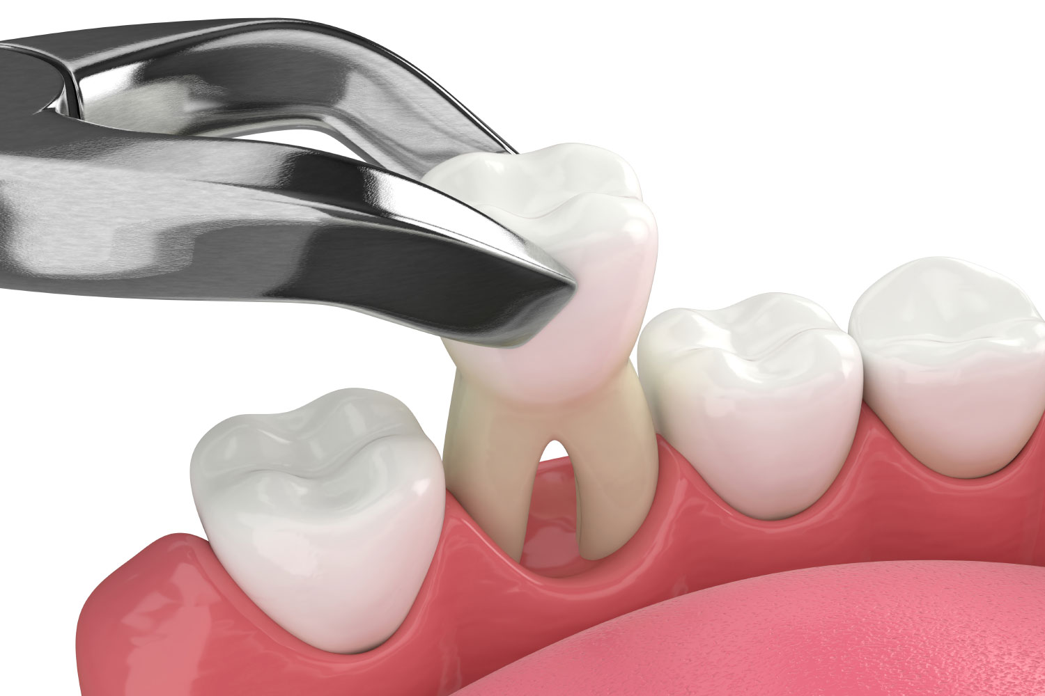 Dental extraction