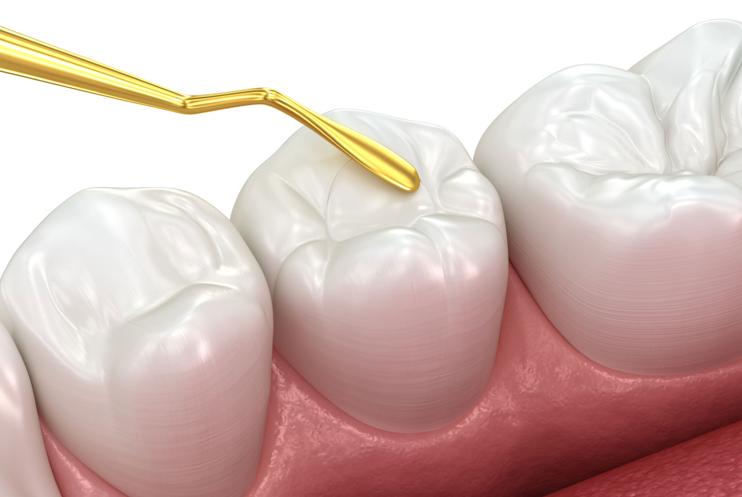 Dental fillings