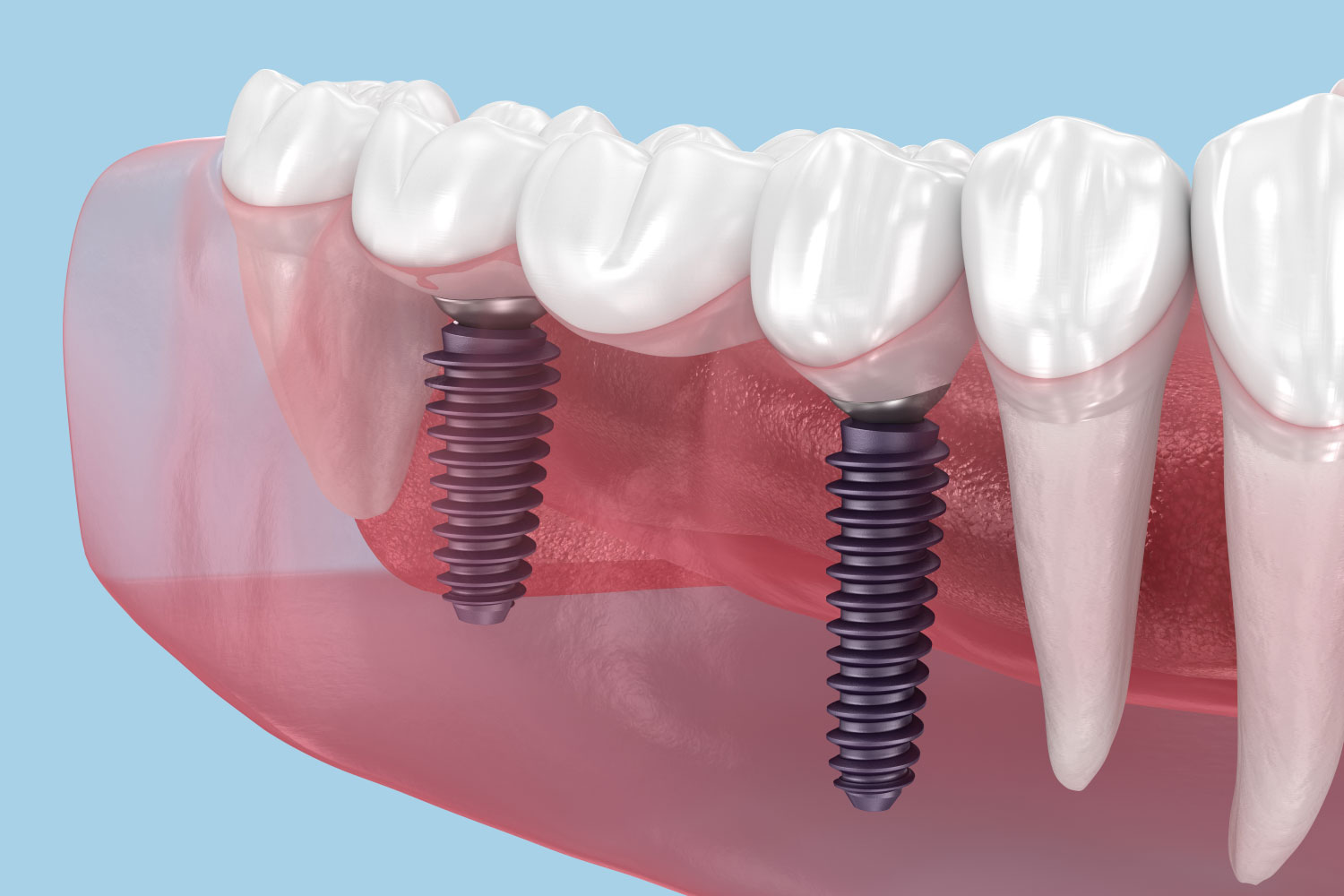 Dental restorative implants