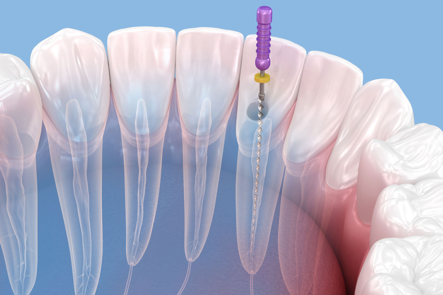 Dental root canal