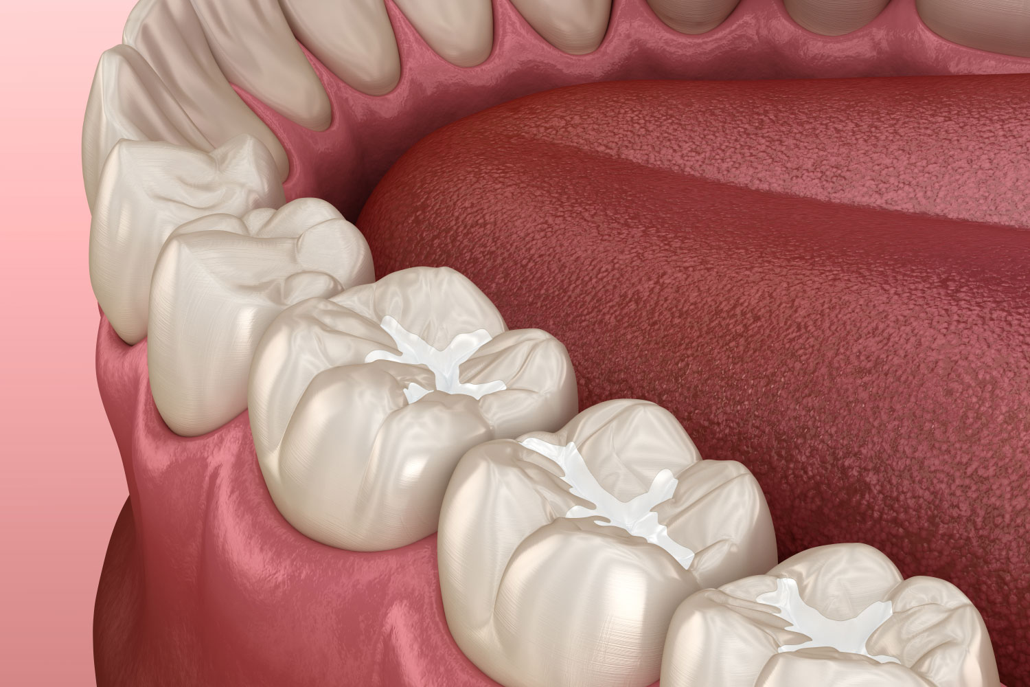 Dental sealant