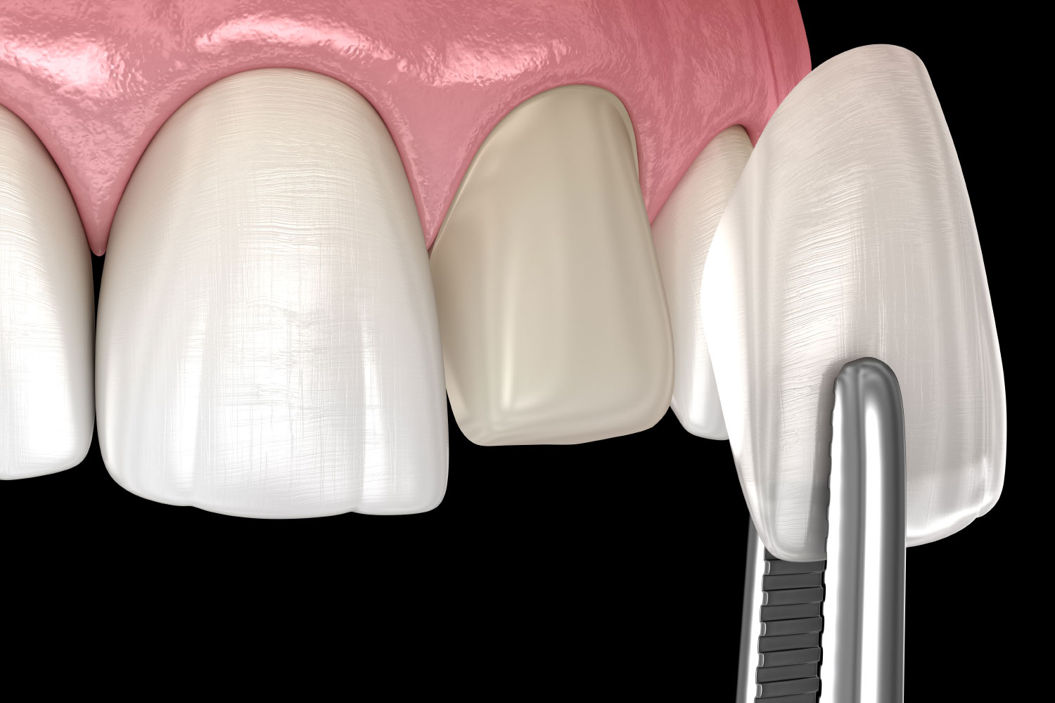 Dental veneers